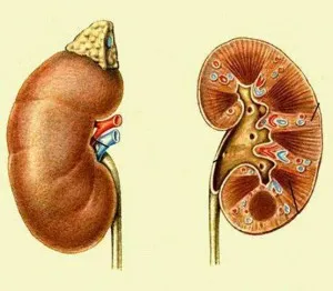 uropatia obstructivă