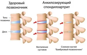 Спондилоартрит що це таке, симптоми, лікування (спондилоартрит симптоми) Спондилоартрит що це таке, симптоми, лікування