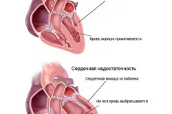 Ускладнення інфаркту міокарда
