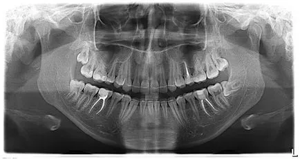 Orthopantomogram vagy panoráma képet, perfectsmile