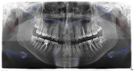 Orthopantomogram vagy panoráma képet, perfectsmile