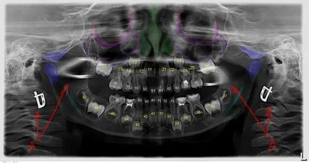 Orthopantomogram vagy panoráma képet, perfectsmile