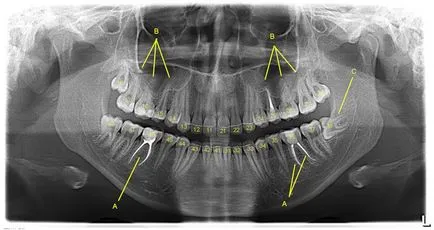 Orthopantomogram sau o imagine panoramică, perfectsmile