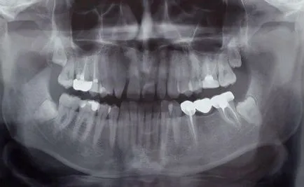 Orthopantomogram sau împușcat panoramică dentară