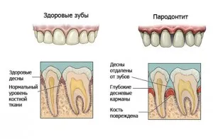 Parodontita - tratament la domiciliu de remedii populare de mestecat