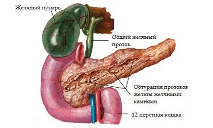 cauze Pancreatita și mecanismul de soiuri de boală