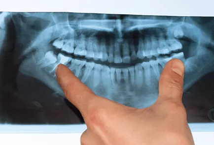 Панорамна снимка - особено ortopantomogrammu зъби