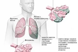 fibroza pulmonara ce este, simptome și tratament