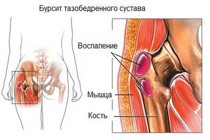 Защо ви боли хип - преглед на възможните причини