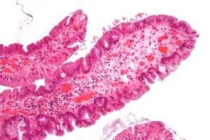 Polypoid sinusitis kezelések és tünetek és krónikus cisztás polypoid