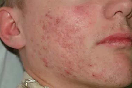 Postacne какво е, снимки на белези