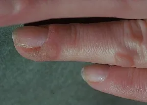 Причината за брадавици по пръстите, брадавици прилича на снимка от това, което се появи между пръстите на краката