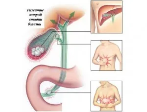 Атаката на камъни в жлъчката заболяване