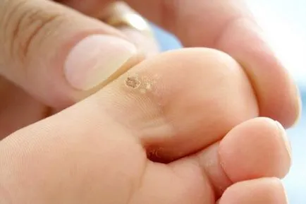 Причината за брадавици по пръстите, брадавици прилича на снимка от това, което се появи между пръстите на краката