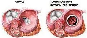 Стеноз мітрального клапана