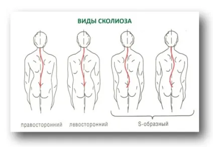 Ступеня, види і стадії сколіозу, їх класифікація (ступеня) Ступеня, види і стадії сколіозу, їх класифікація