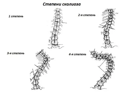 Ступеня, види і стадії сколіозу, їх класифікація (види) Ступеня, види і стадії сколіозу, їх класифікація