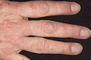 Psoriasis tünetei és jelei a nők, férfiak és gyermekek