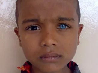 Едно дете с различен цвят на очите, което определя цвета на очите