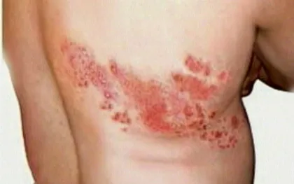 Pityriasis versicolor kezelésére és okait