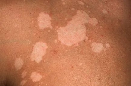 Pityriasis versicolor kezelésére és okait