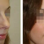 Corectia nasului lung - Poze inainte si dupa