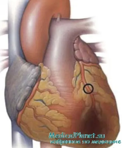 Режим след инфаркт на миокарда - сърцето третиране
