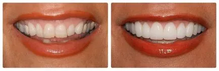 възстановяване на зъбите фасети как лустрото избор