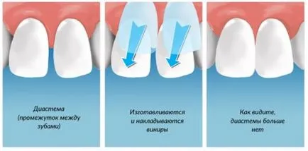 fogpótlás héjak, hogy a választás furnér