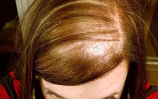 alopecie seboreica la femei - cauze si tratament (display-uri foto)