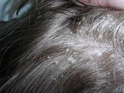 Seborrheic alopecia nőknél, a tünetek, a kezelés