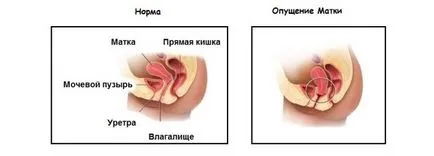 Симптоми, лечение и отзиви за него за маточната пролапс