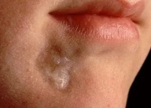 Cauzele sclerodermia, simptome, tratament (foto și video)