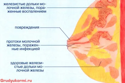 Як визначити застій молока у годуючої матері лактостаз, його симптоми і лікування в домашніх умовах (молока) Як визначити застій молока у годуючої матері лактостаз, його симптоми і лікування в домашніх умовах