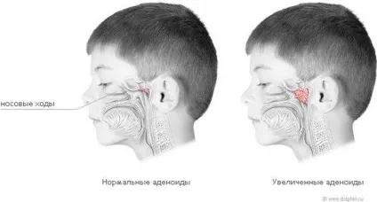 Сухий кашель у дитини вночі як заспокоїти, причини, як зупинити, ніж лікувати, полегшити
