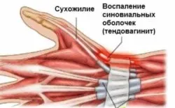 сухожилие теносиновит четки симптоми и лечение на ръцете