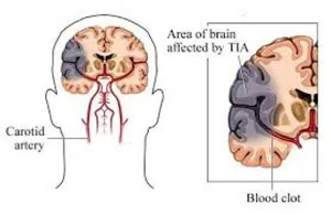 TIA vertebrobasilaris medencében tünetek, kezelés, prognózis és intézkedések