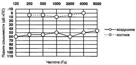 Tonális küszöb audiometria