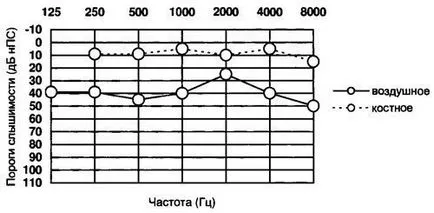 Tonális küszöb audiometria