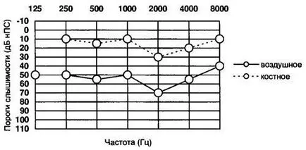 Tonális küszöb audiometria