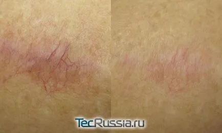 Îndepărtarea cu laser a cicatricilor si cicatrici - o procedură, fotografii, recenzii și tarife
