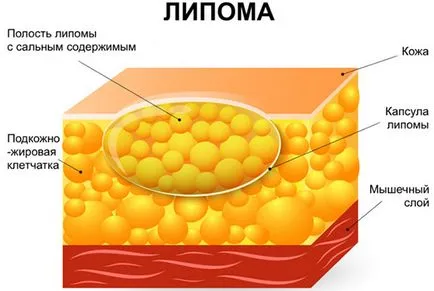 Премахване на признания липоми лазер на пациентите, противопоказания, възможни последствия, цени