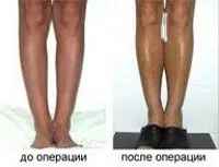 Creșterea gambe (artroplastie) - prețurile la Moscova au găsit 84 prețuri