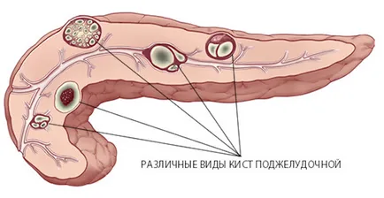 Creșterea ecogenicitate a pancreasului - există nici un motiv să se teamă