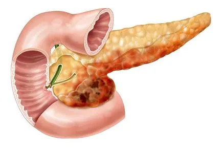 Creșterea ecogenicitate a pancreasului - există nici un motiv să se teamă