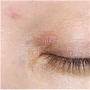 Bőrápolási a szem körül az alapvető szabályokat, szalon kezelések, hagyományos receptek