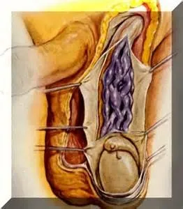Варикоцеле - лечение, хирургия, симптоми, причини, ефекти