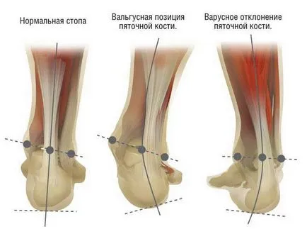 Valgus деформация на големия пръст на крака за лечение на кривина