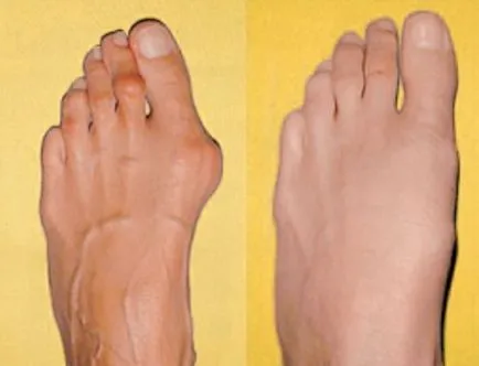 Valgus deformitás láb felnőtteknél okoz, mértékét, tünetei és kezelése