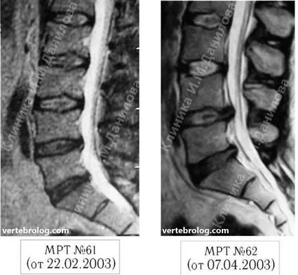 гръбначния сцепление провокира херния